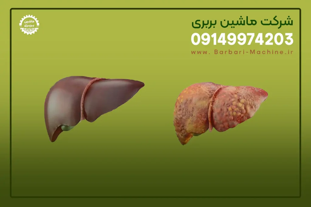 کبد چرب چیست توضیحات کلی در مورد کبد چرب